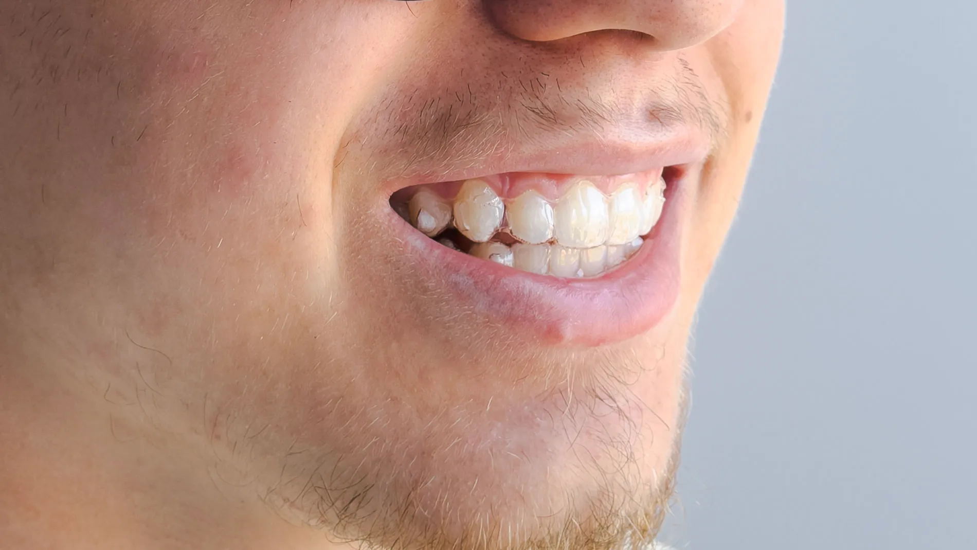 Patient smiling during treatment with clear aligners